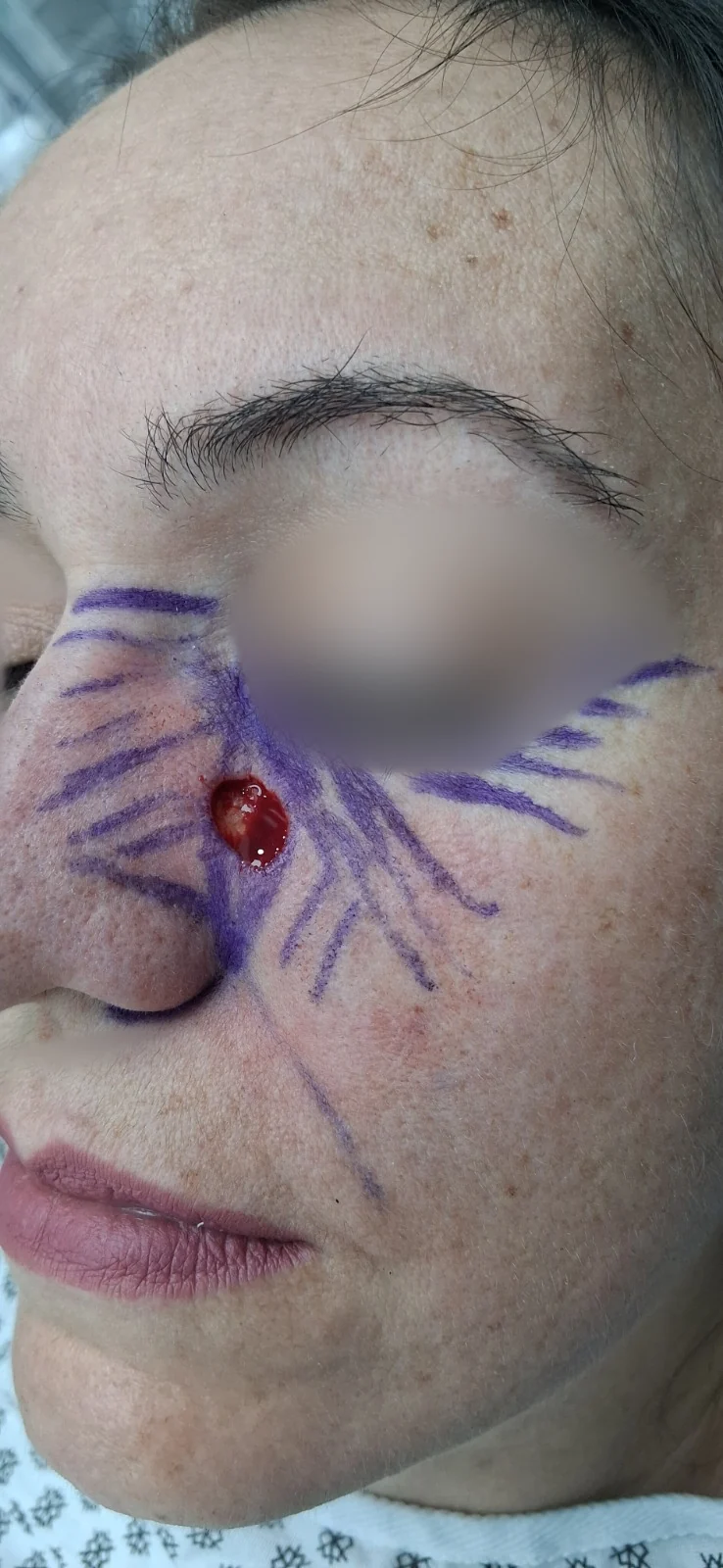 Carcinoma basocelular: Durante el procedimiento