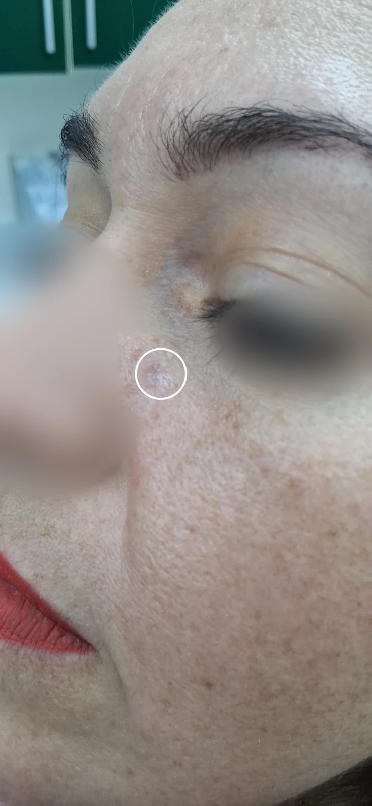 Carcinoma basocelular: vista clínica