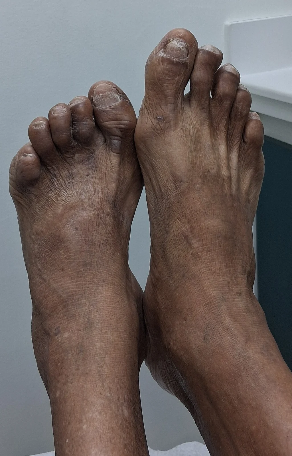 Curiosidad dermatológica en los pies: Vista dorsal