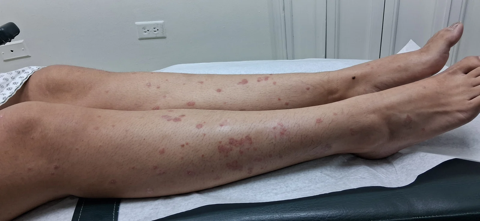Psoriasis guttata: Antes