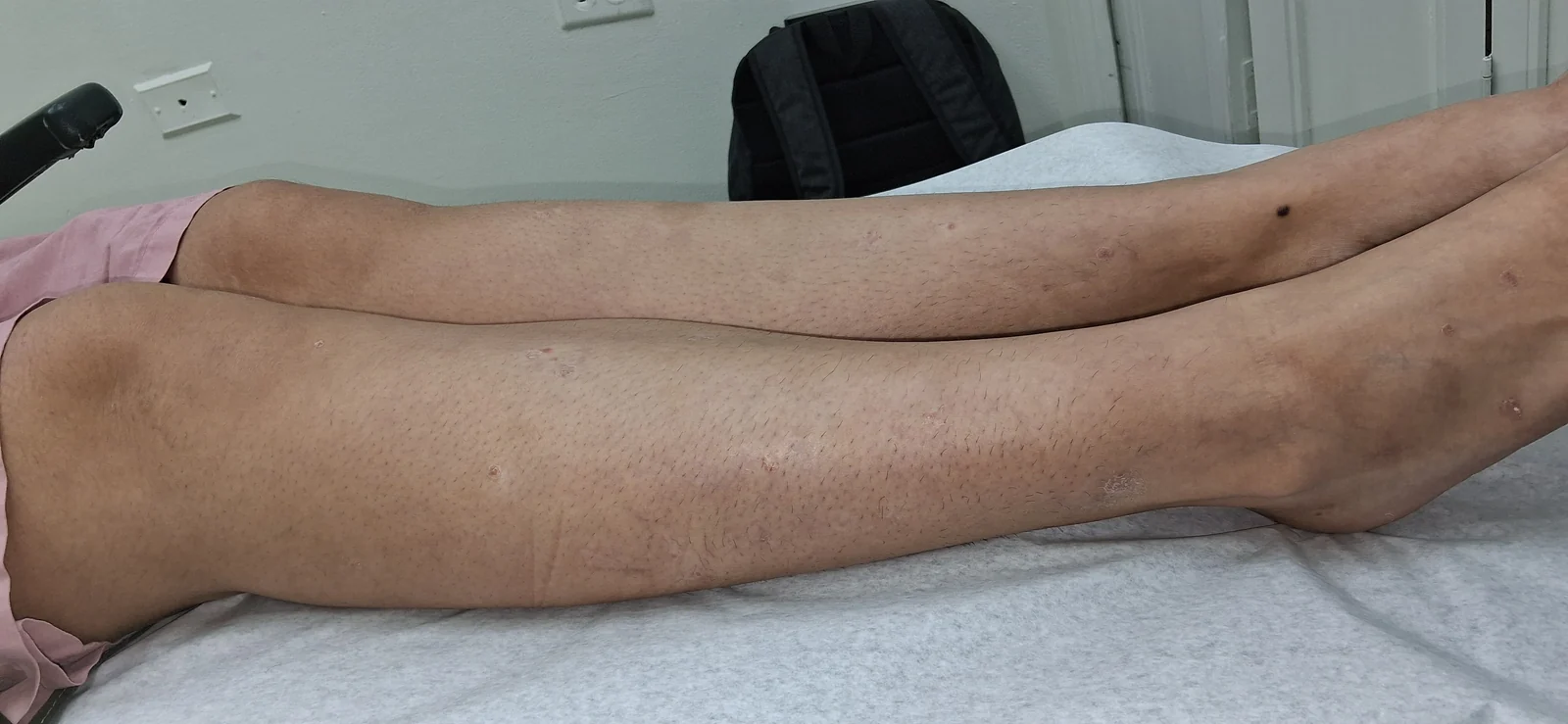 Psoriasis guttata: Seguimiento