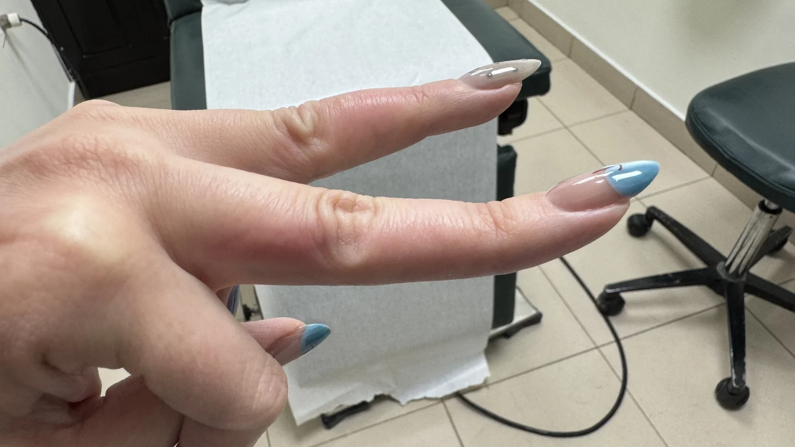 Quemadura en un dedo de la mano: vista clínica