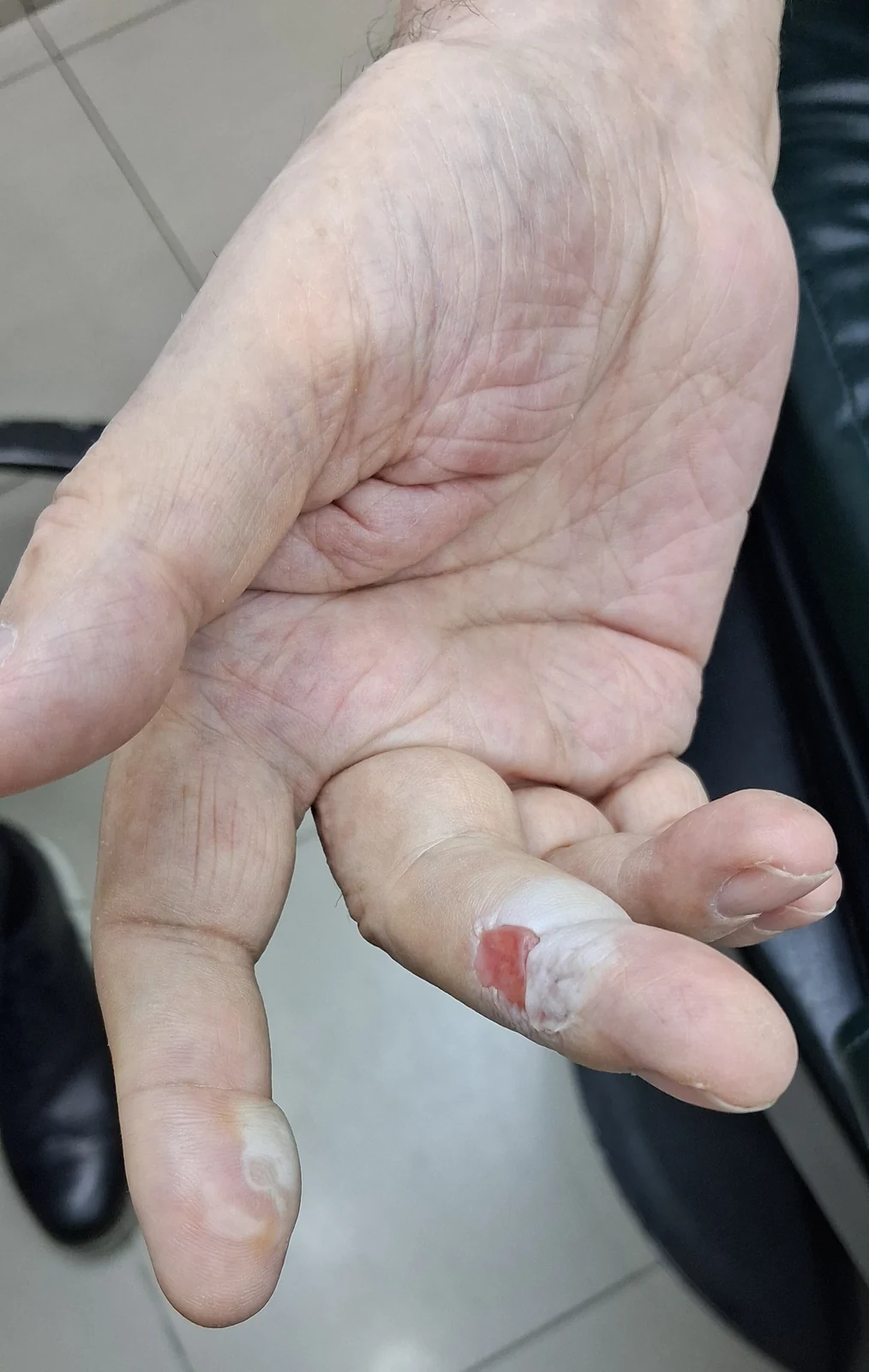 Quemadura en la mano: vista clínica