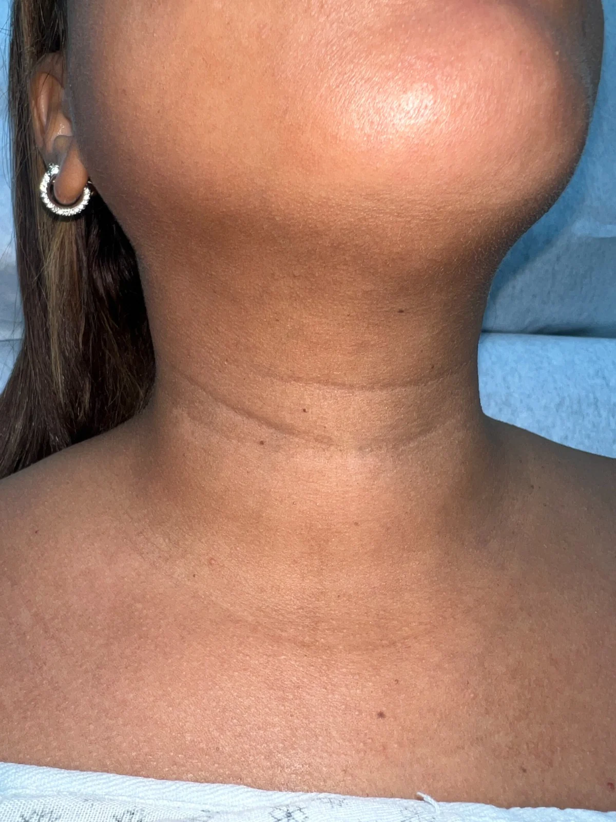 Queratosis seborreica: Antes
