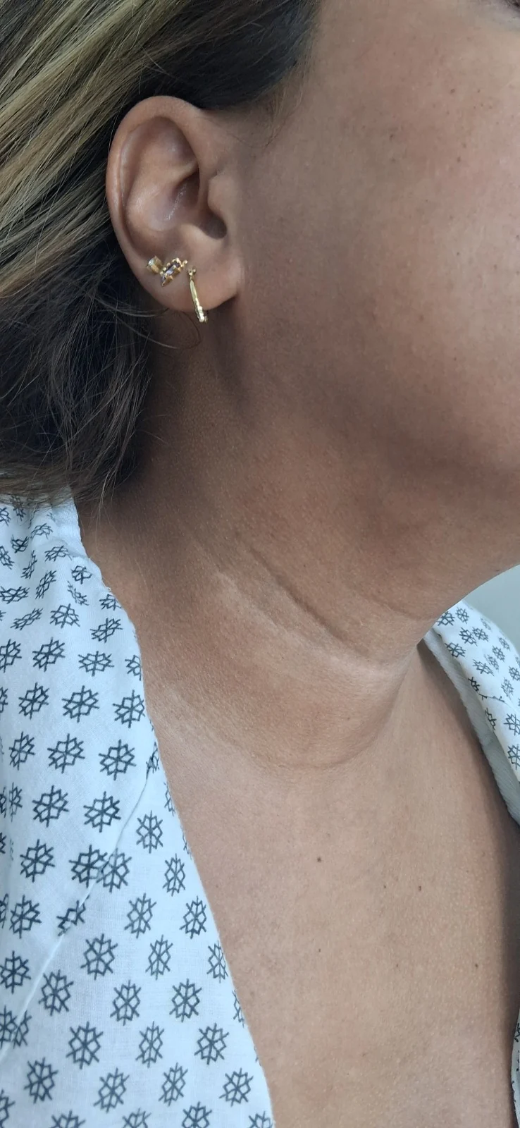Queratosis seborreica: Seguimiento