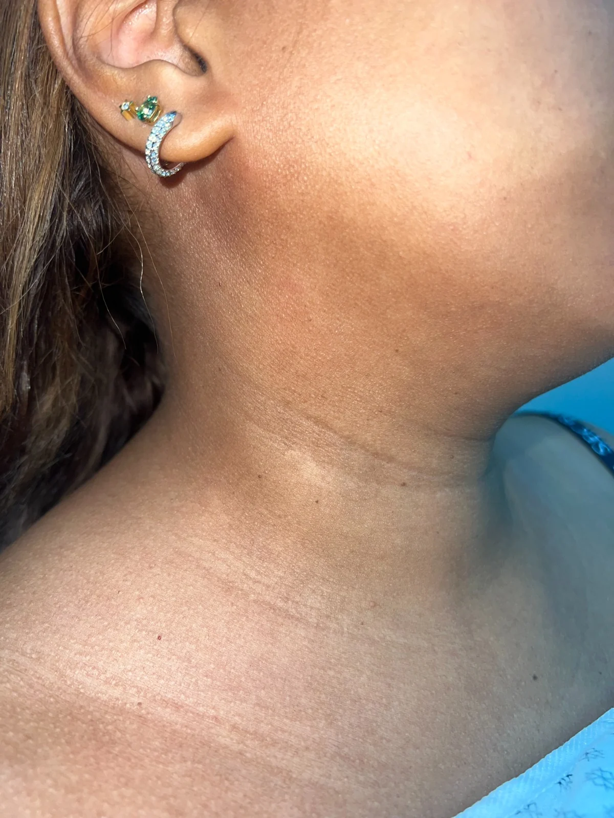 Queratosis seborreica en el cuello: vista clínica