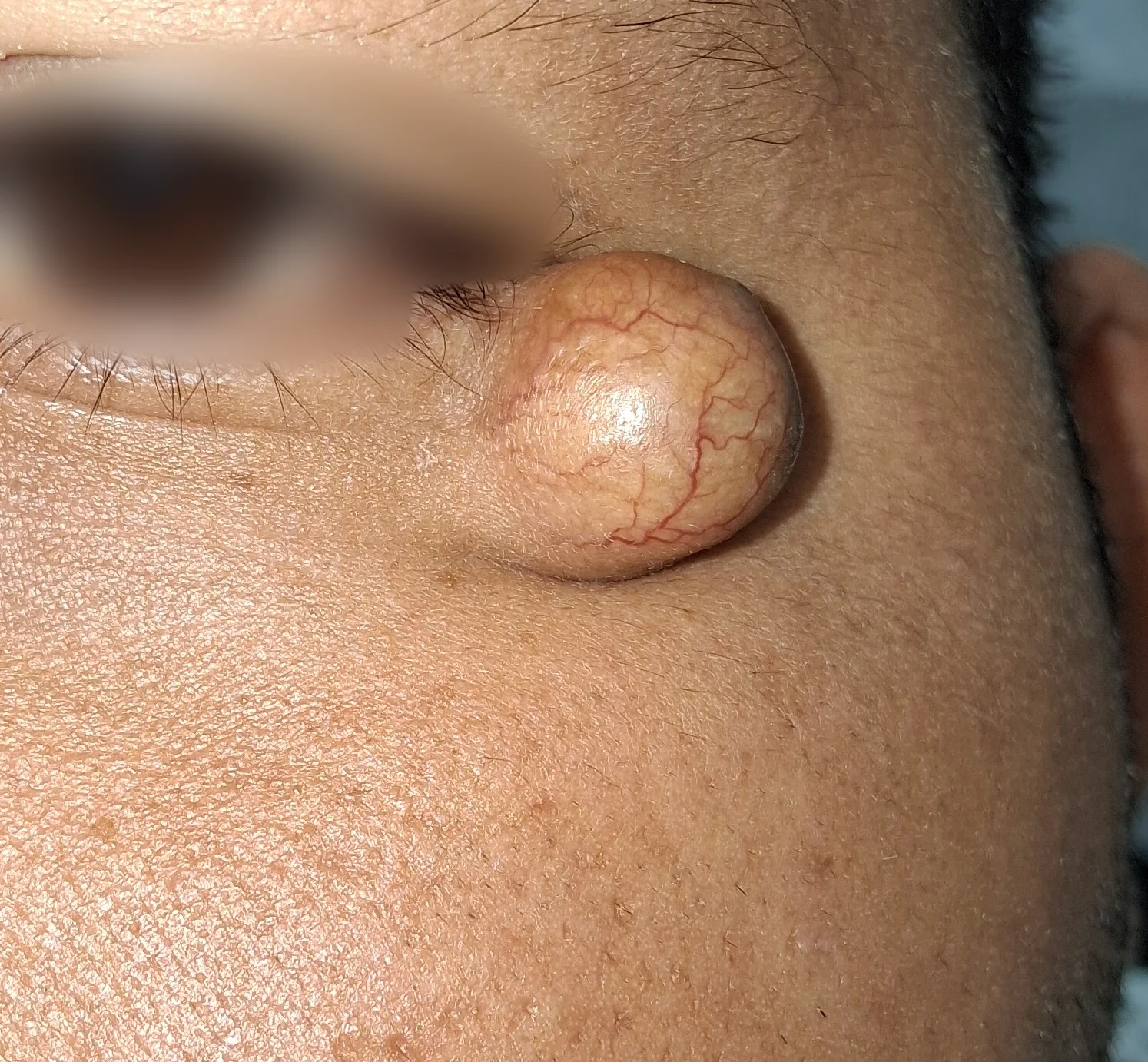 Quiste epidermoide: vista clínica