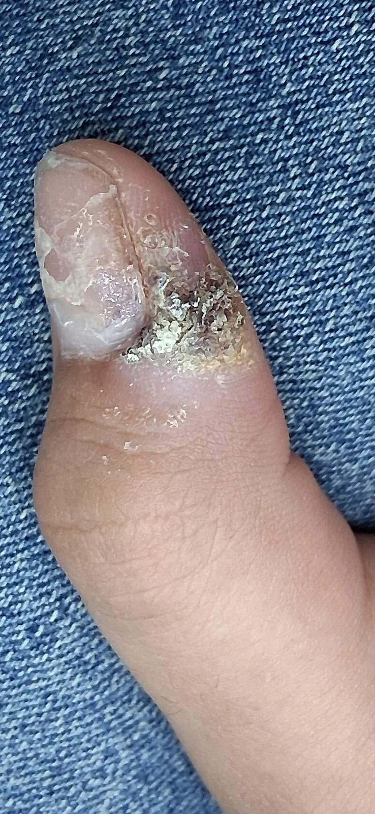 Verruga vulgar en el pulgar: vista clínica