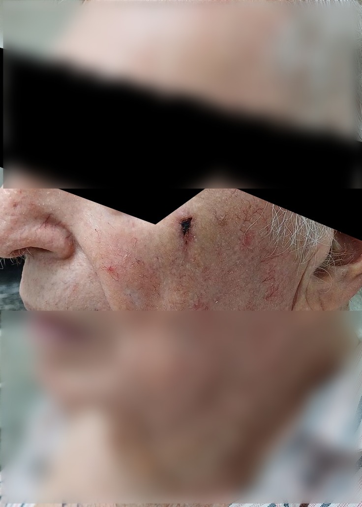Carcinoma escamoso: imagen antes