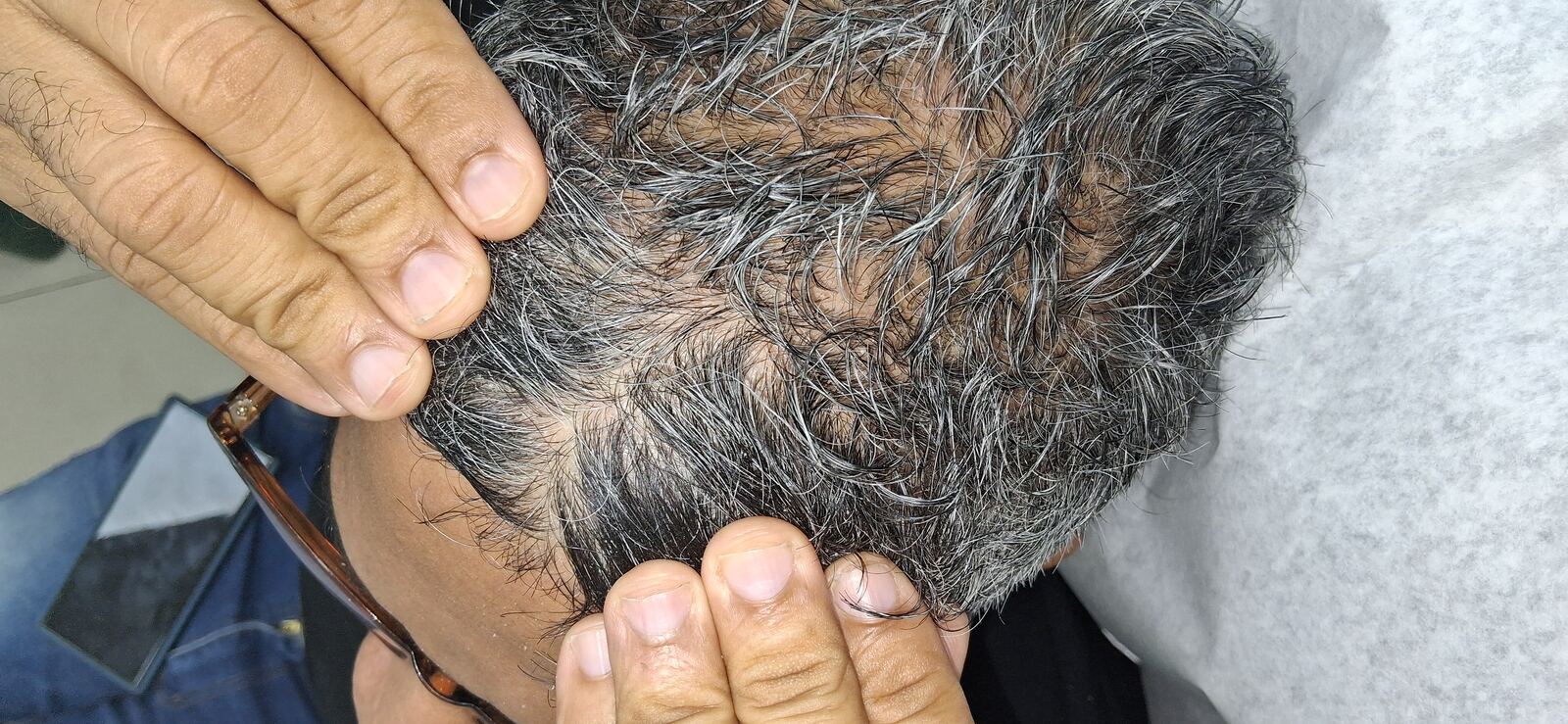 Dermatitis liquenoide vs psoriasis: imagen después