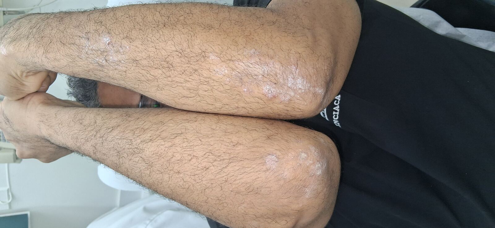 Caso clínico de Dermatitis liquenoide vs psoriasis