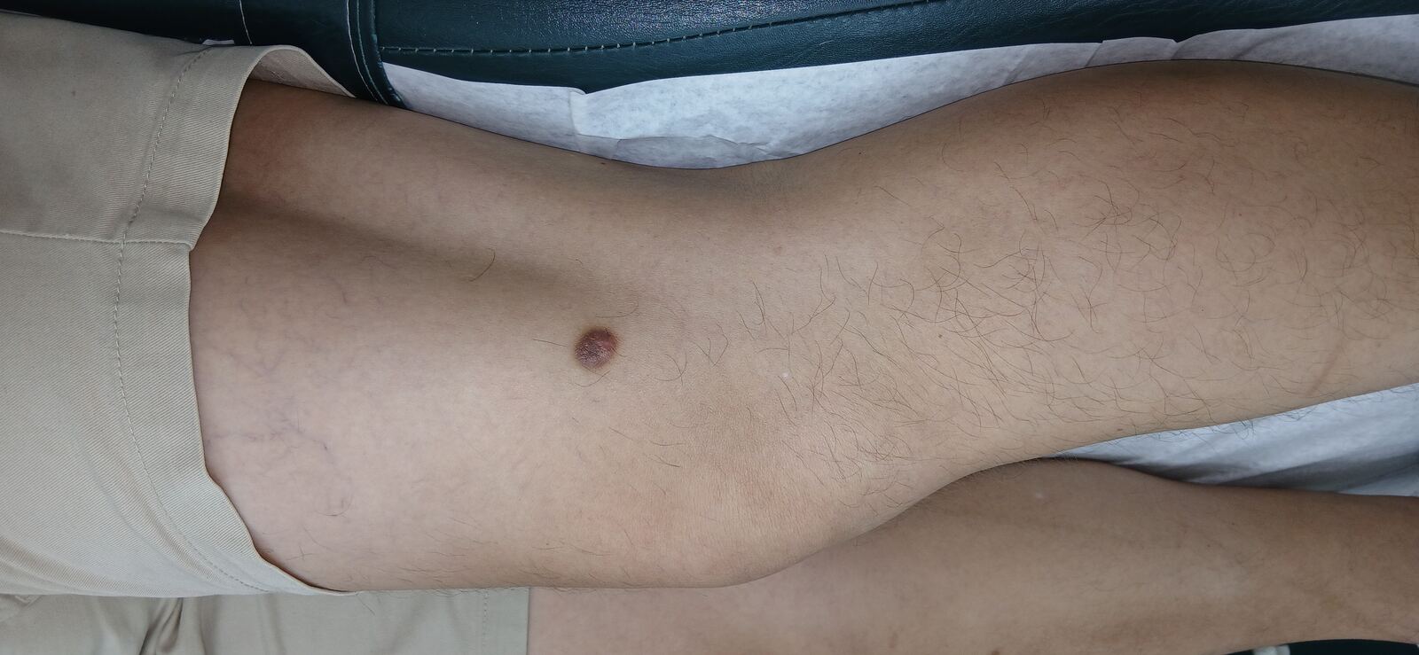 Dermatofibroma y queloide: imagen después