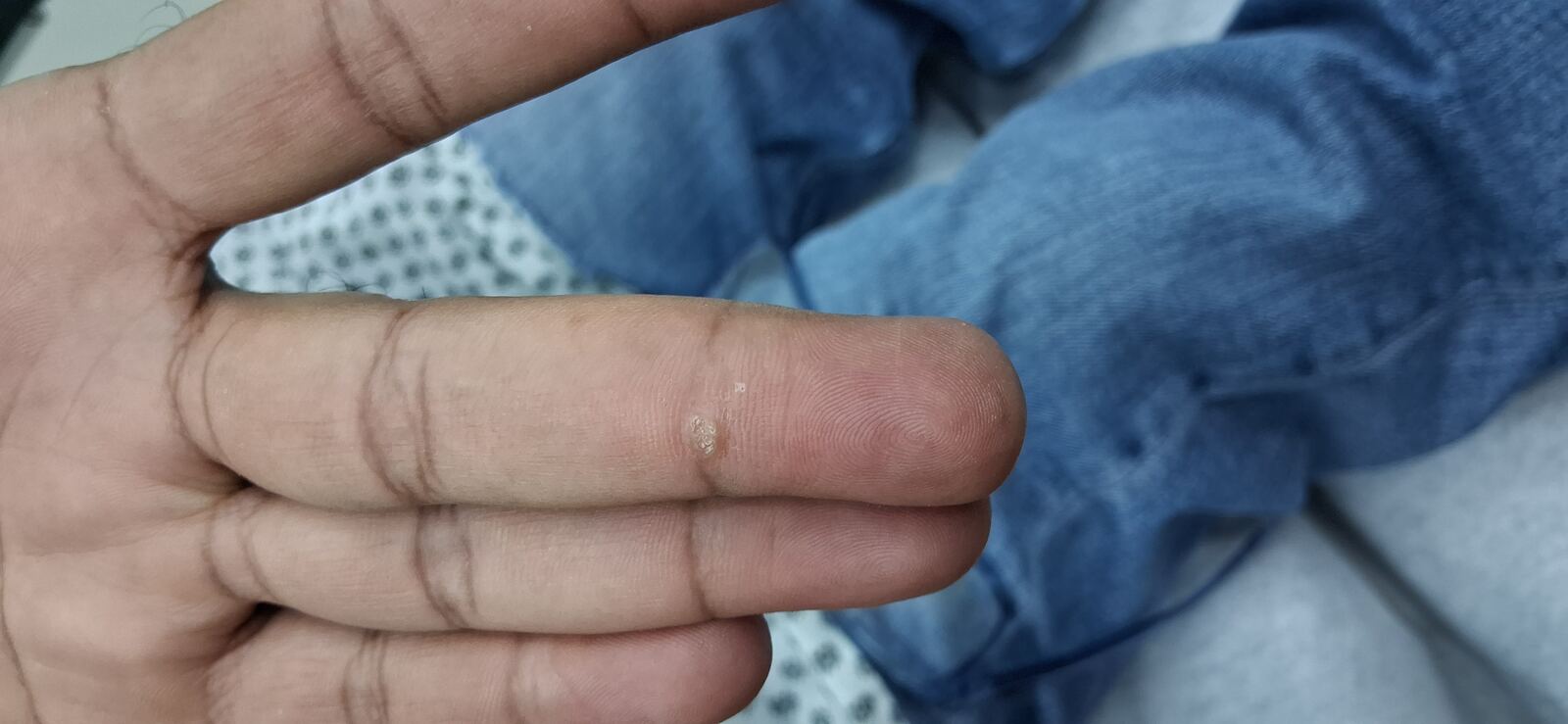 Caso clínico de Fibroqueratoma vs verruga