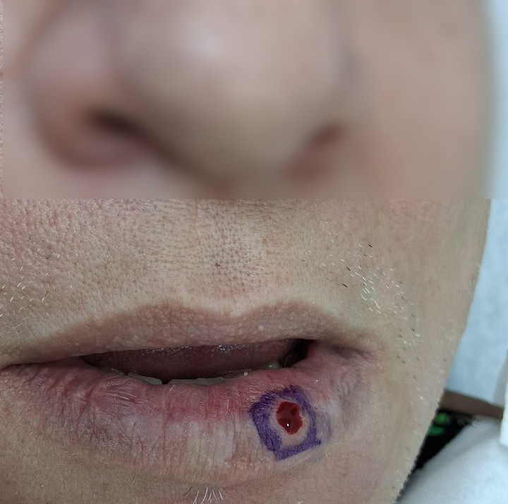 Lago venoso vs nevus: imagen antes