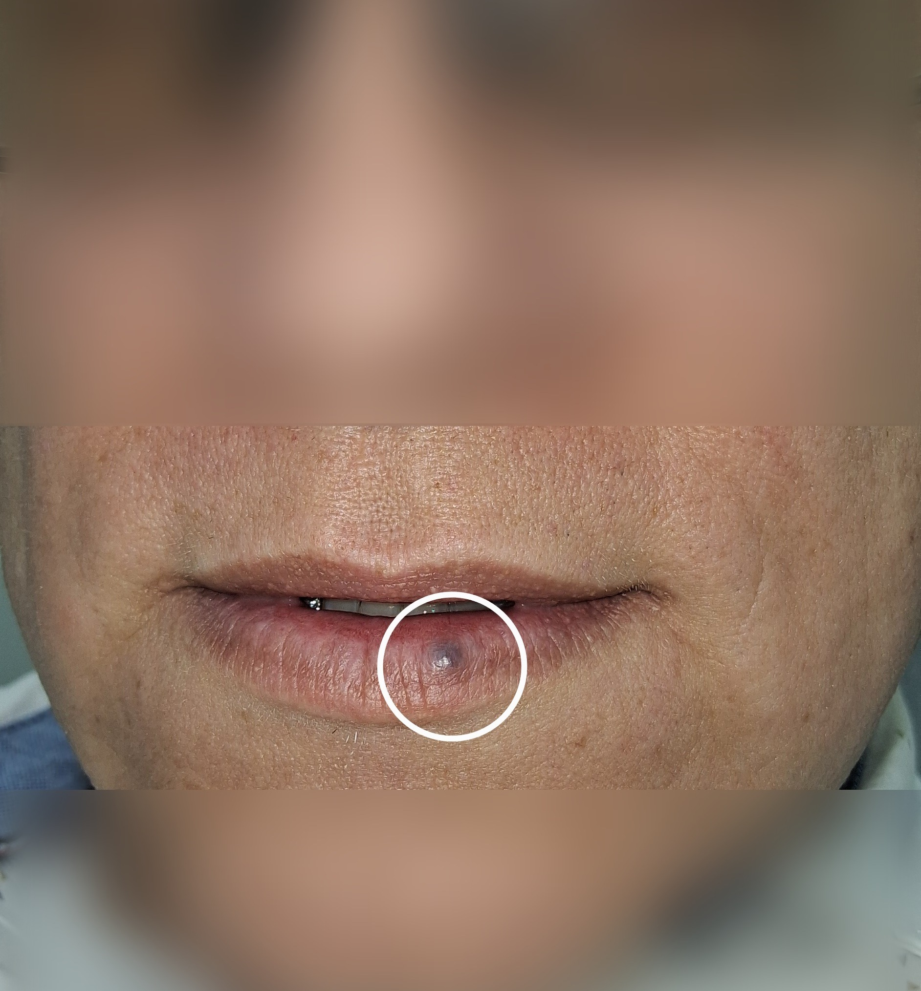 Lago venoso vs nevus: imagen después