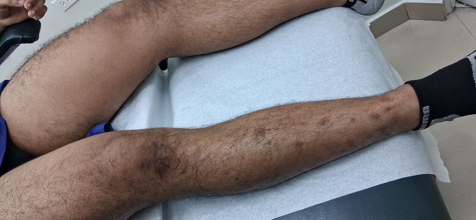 Caso clínico de Liquen simplex crónico