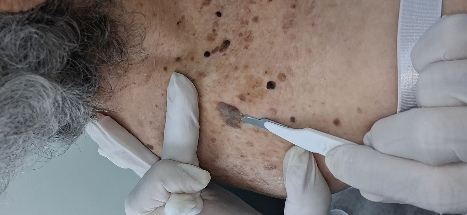 Melanoacantoma: imagen antes