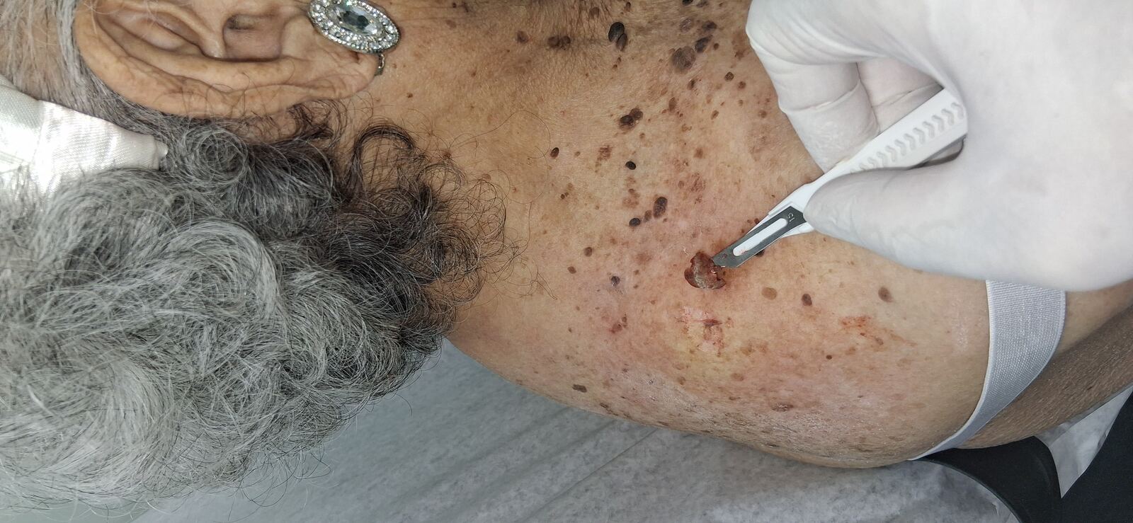 Melanoacantoma: imagen después