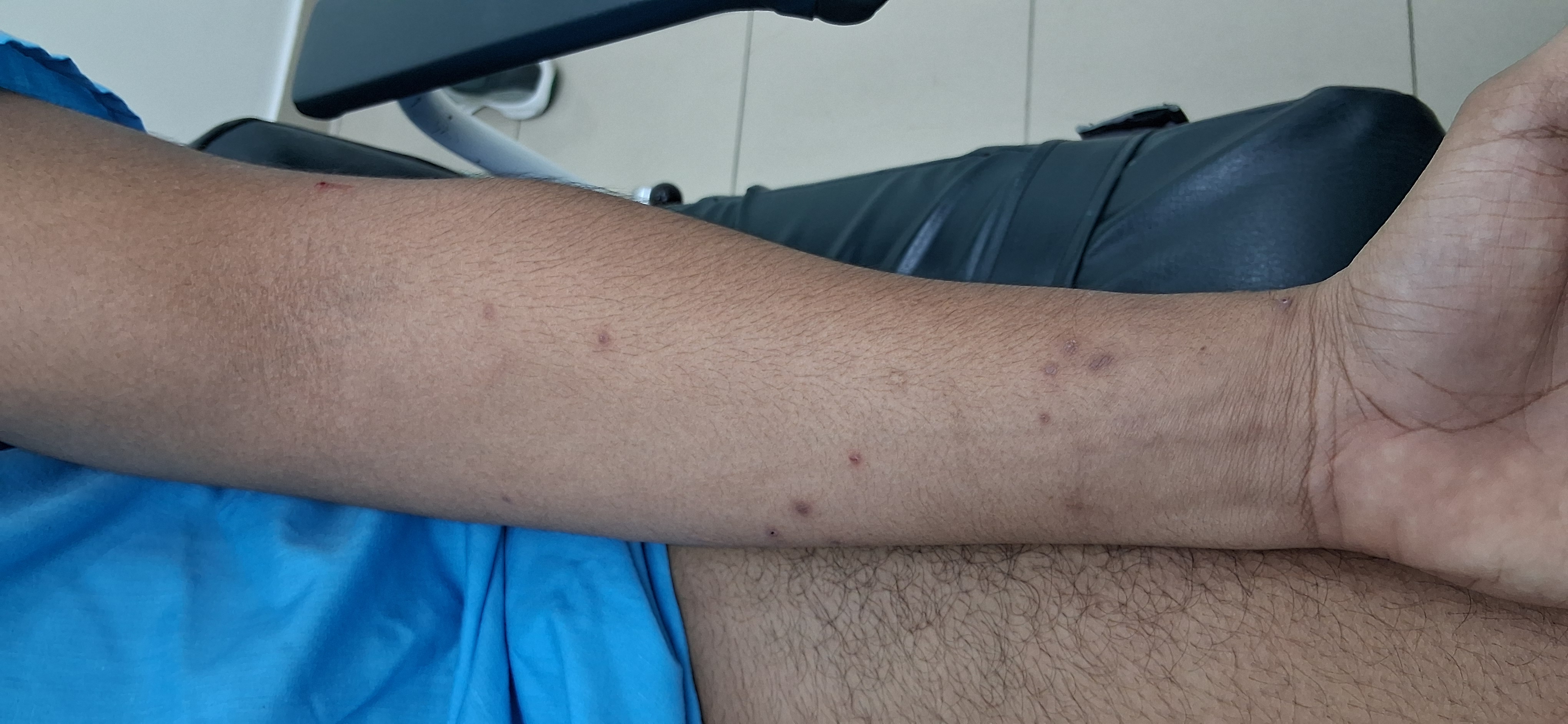 Caso clínico de Molusco contagioso