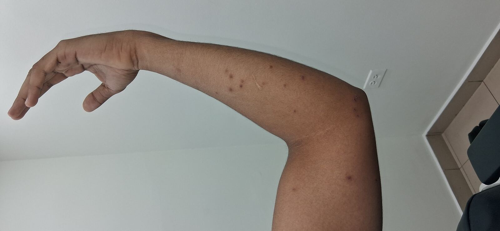 Caso clínico de Molusco contagioso