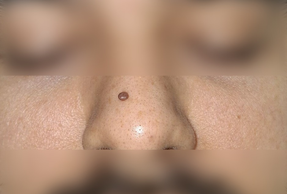 Nevus pedunculado: imagen antes