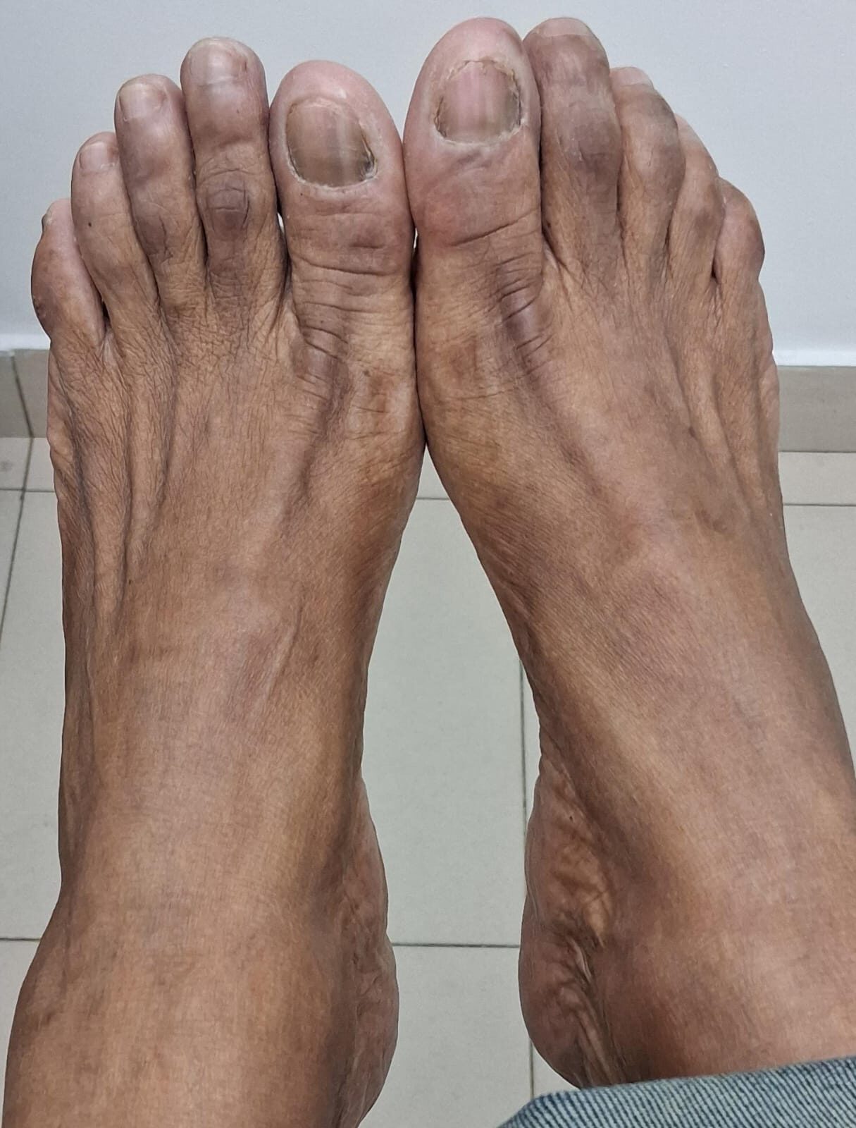 Onicomicosis en manos y pies: imagen después