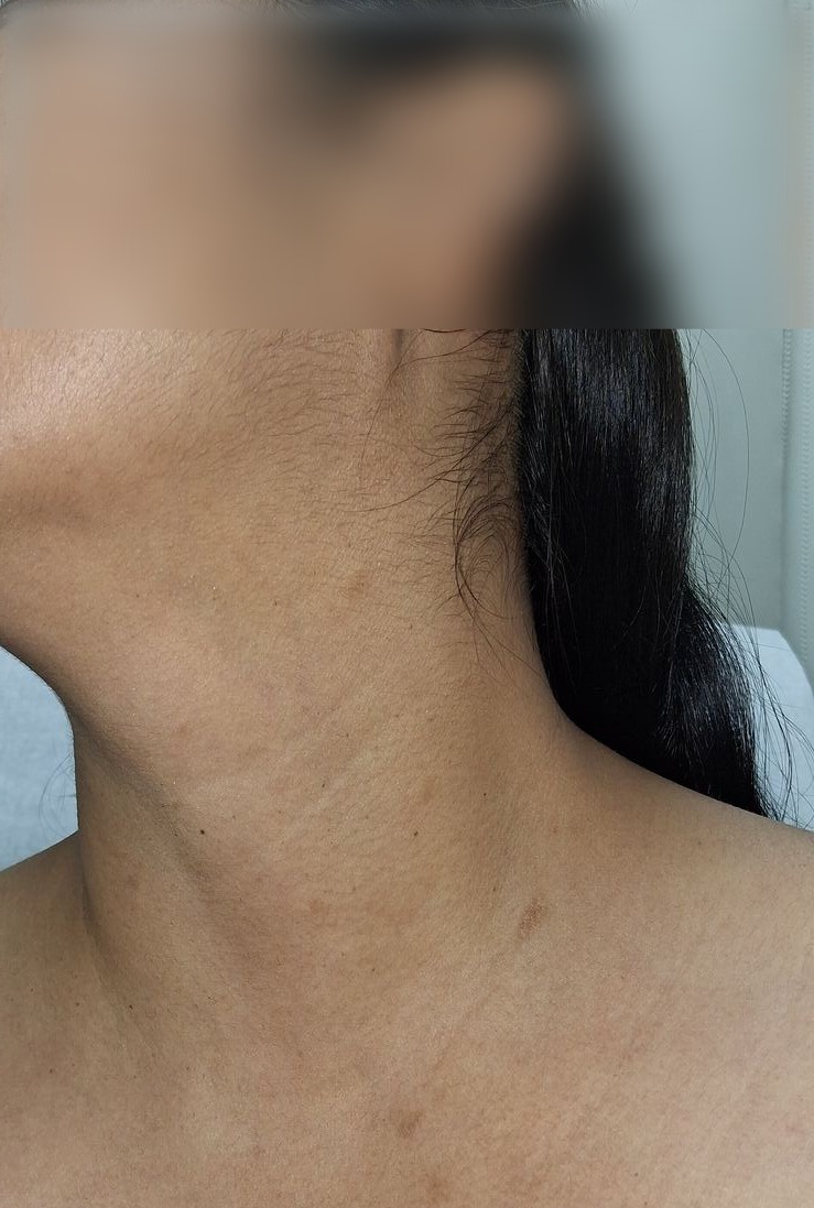 Pitiriasis rosada: imagen antes