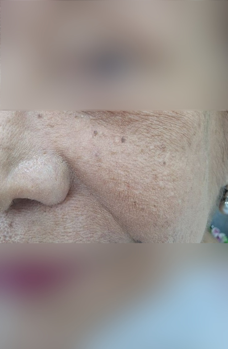 Caso clínico de Queratosis actínica