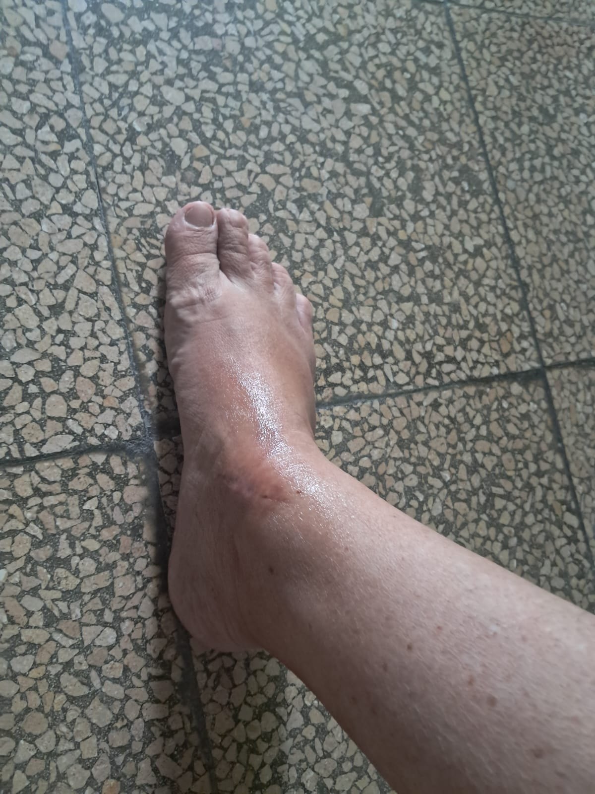 Tumor mixto: imagen después