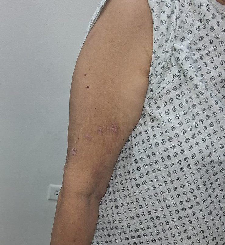 Varicela zoster: imagen antes