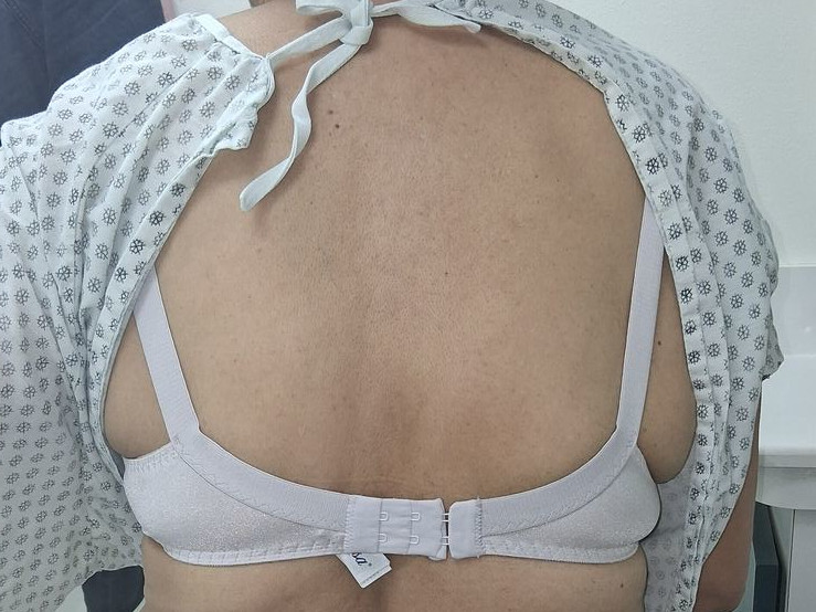 Varicela zoster: imagen después