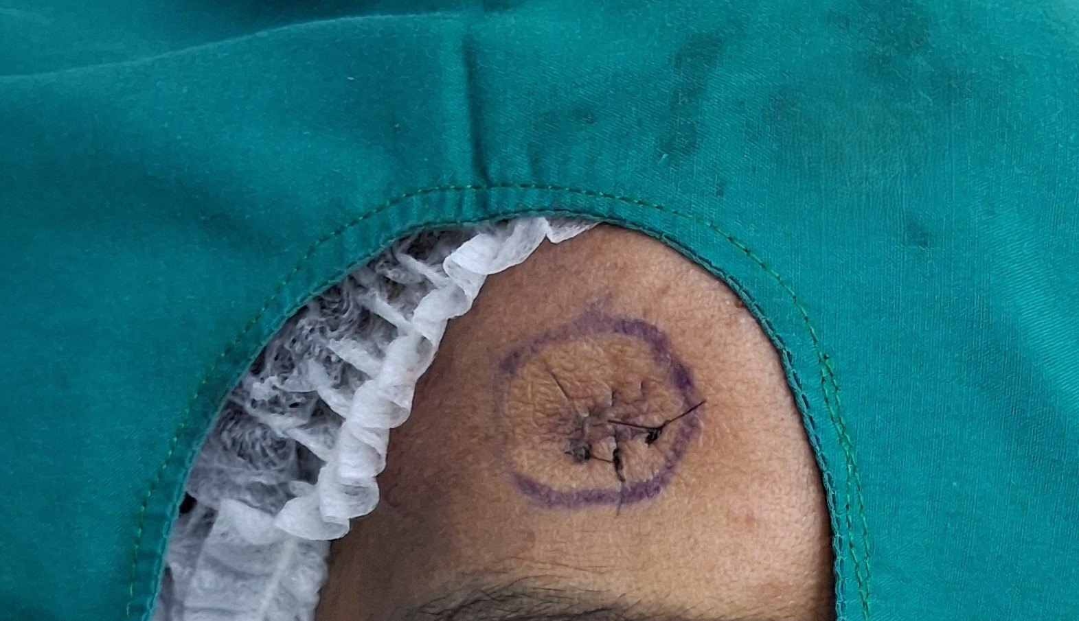 Antes: Lipoma