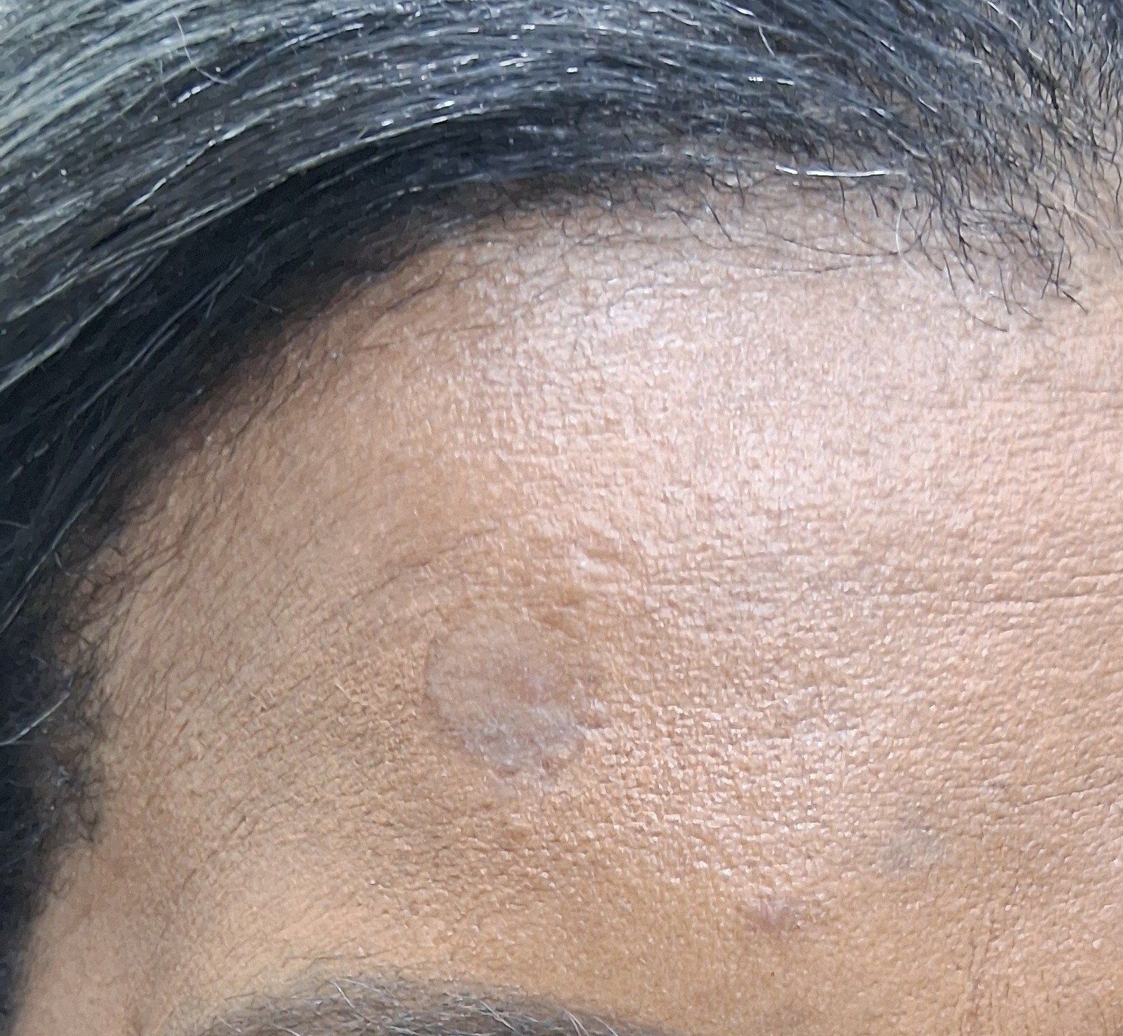 Después: Lipoma