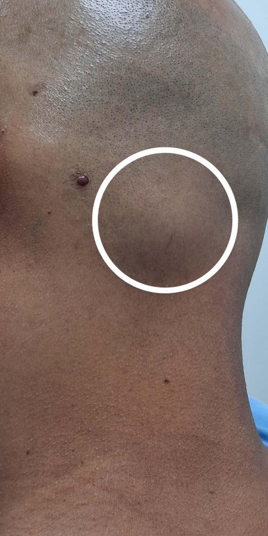 Antes: Lipoma