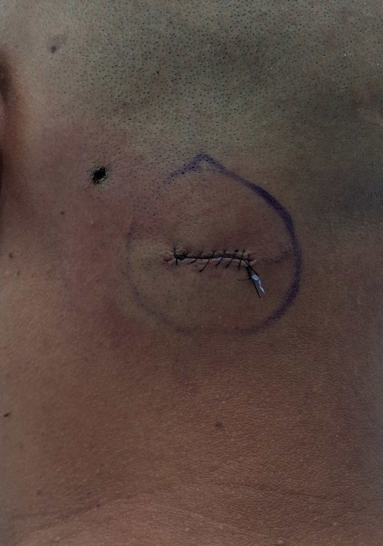 Después: Lipoma