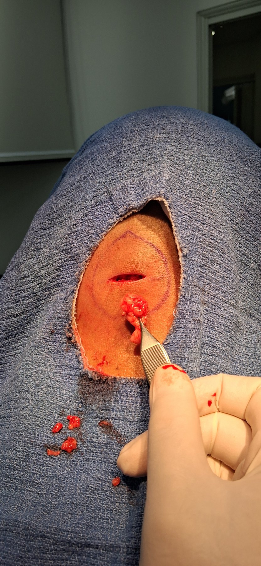 Lipoma