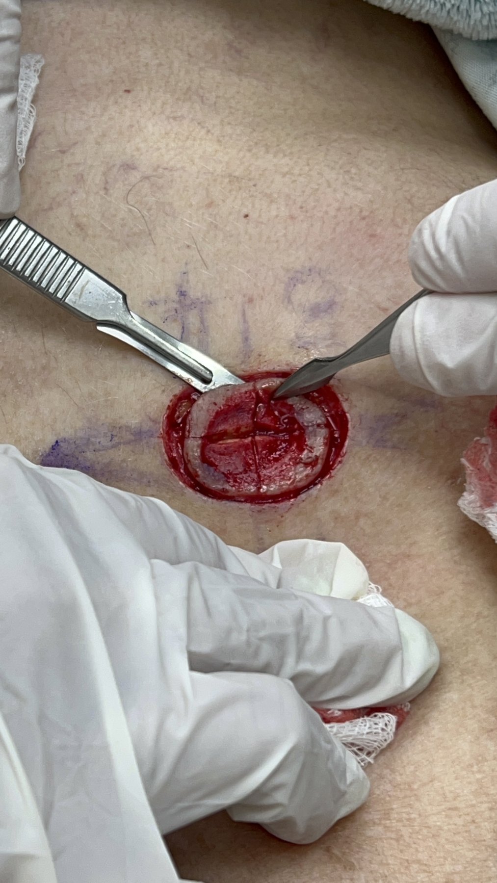 Antes: Cirugía de Mohs con control microscópico  y reconstrucción