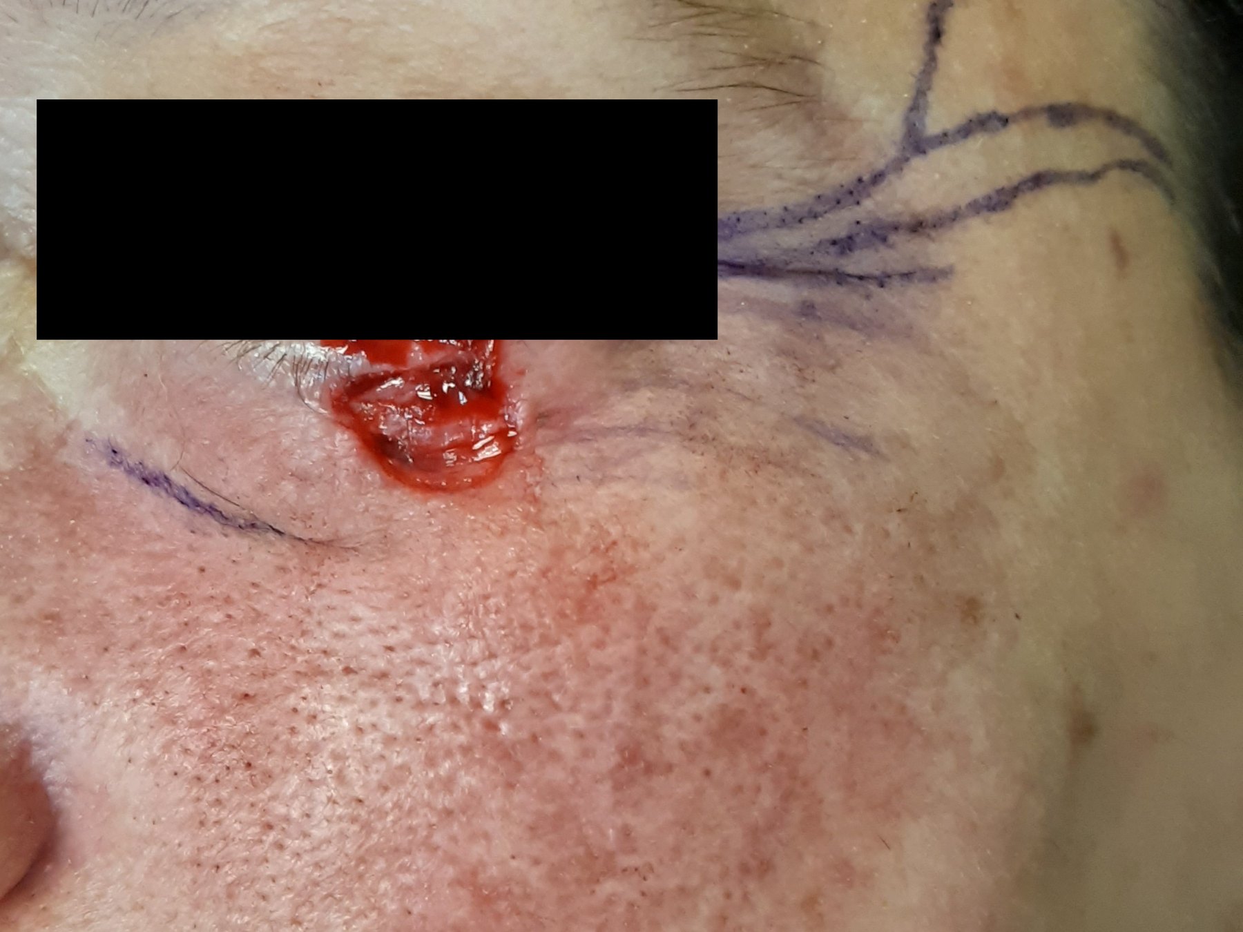 Antes: Cirugía de Mohs con control microscópico y reconstrucción