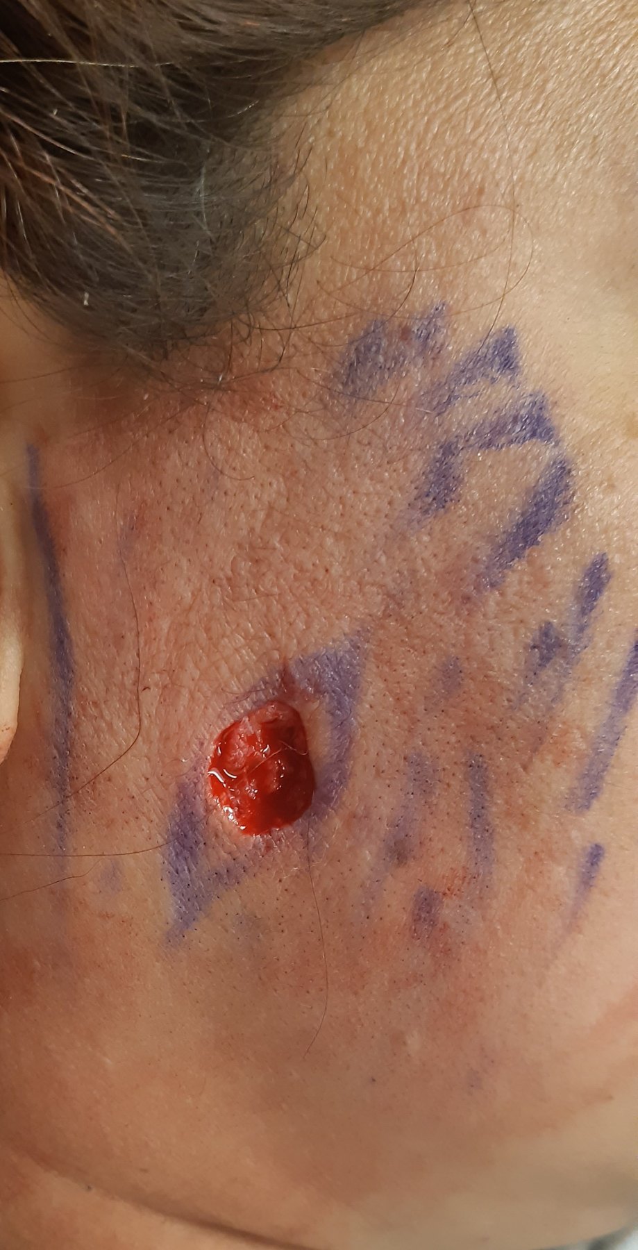 Antes: Cirugía de Mohs con control microscópico  y reconstrucción
