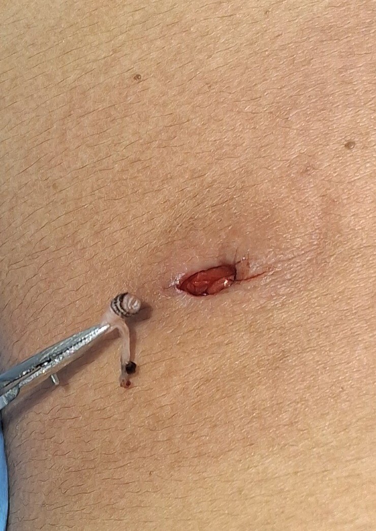 Antes: Miasis Cutánea ( Larva )