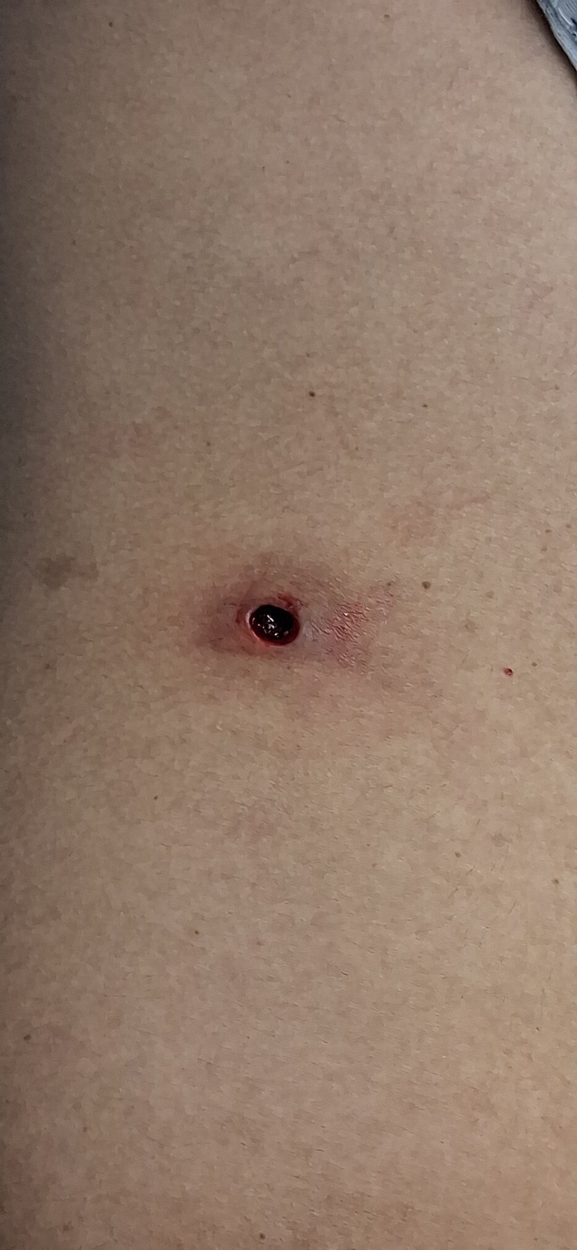 Después: Miasis Cutánea ( Larva )