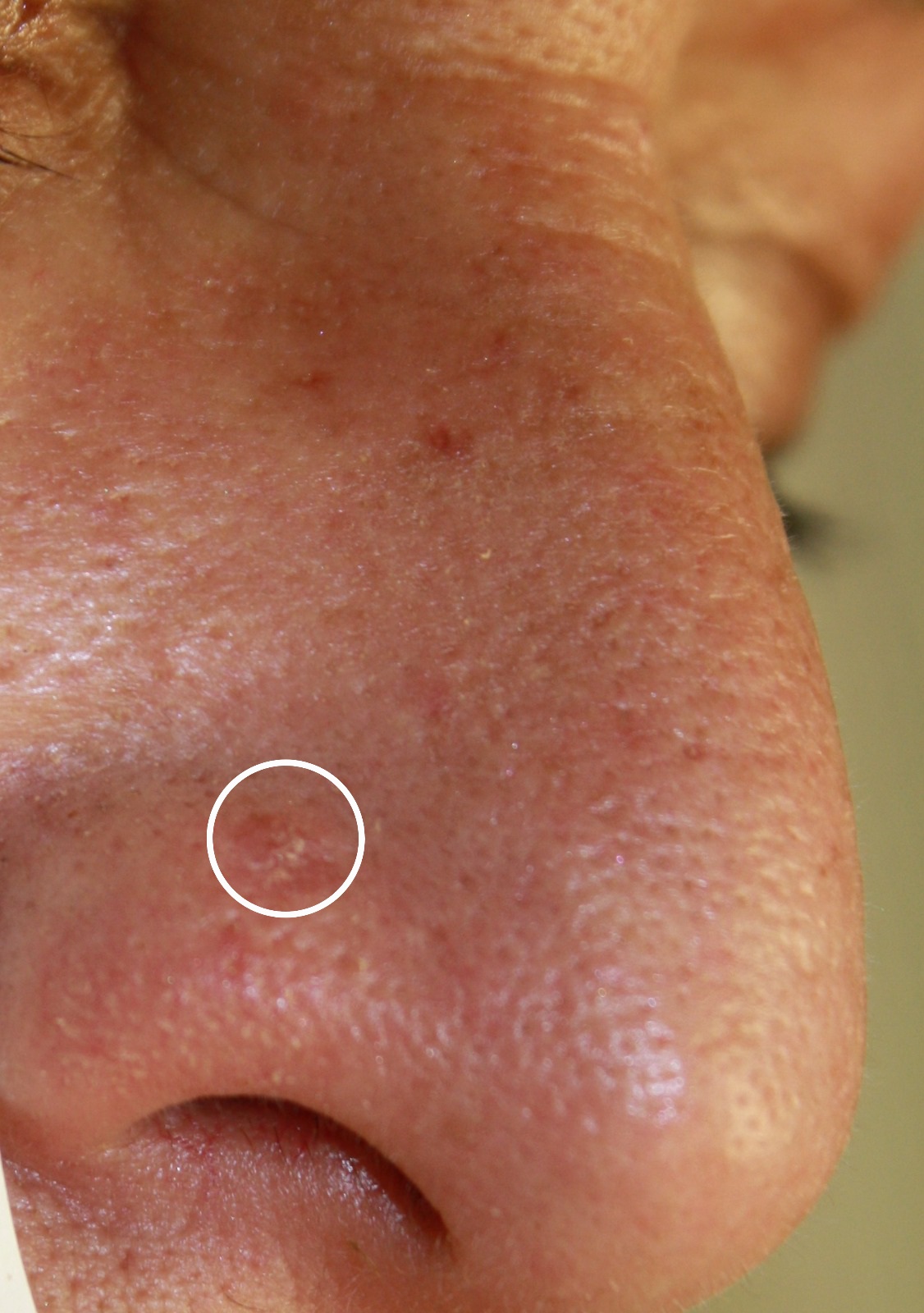 Cirugía de Mohs con control microscópico y reconstrucción