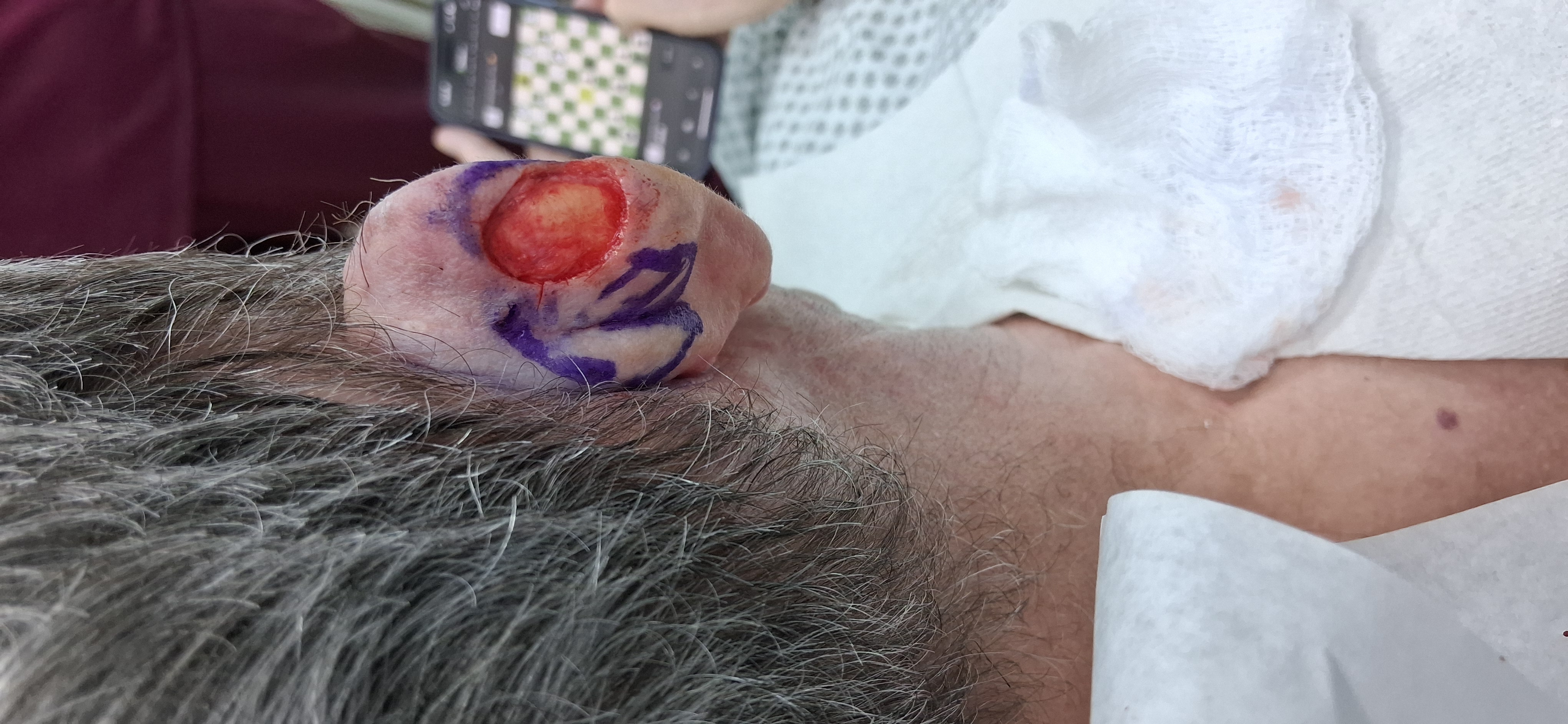 Antes: Cirugía de Mohs con control microscópico y reconstrucción