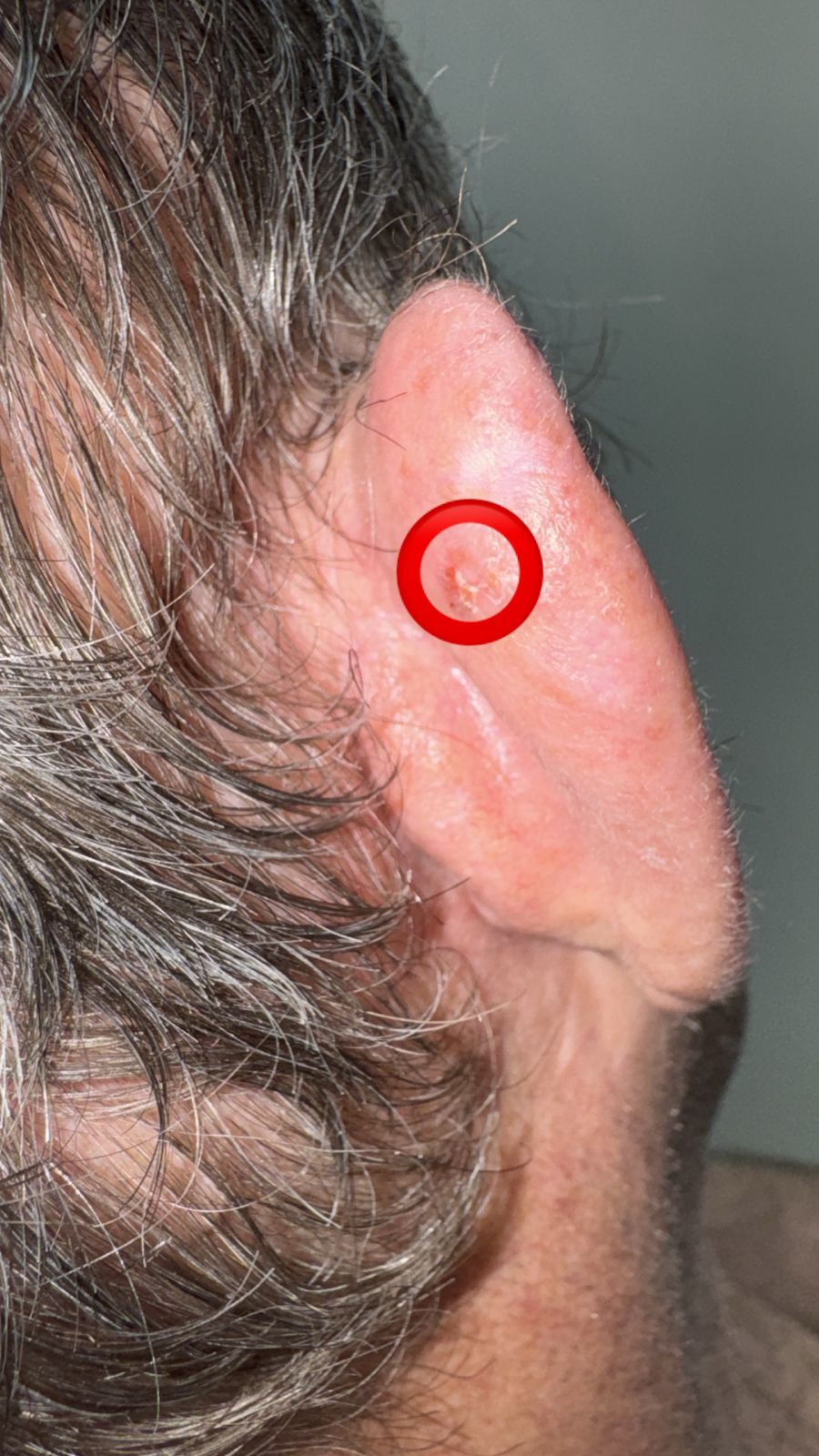 Cirugía de Mohs con control microscópico y reconstrucción