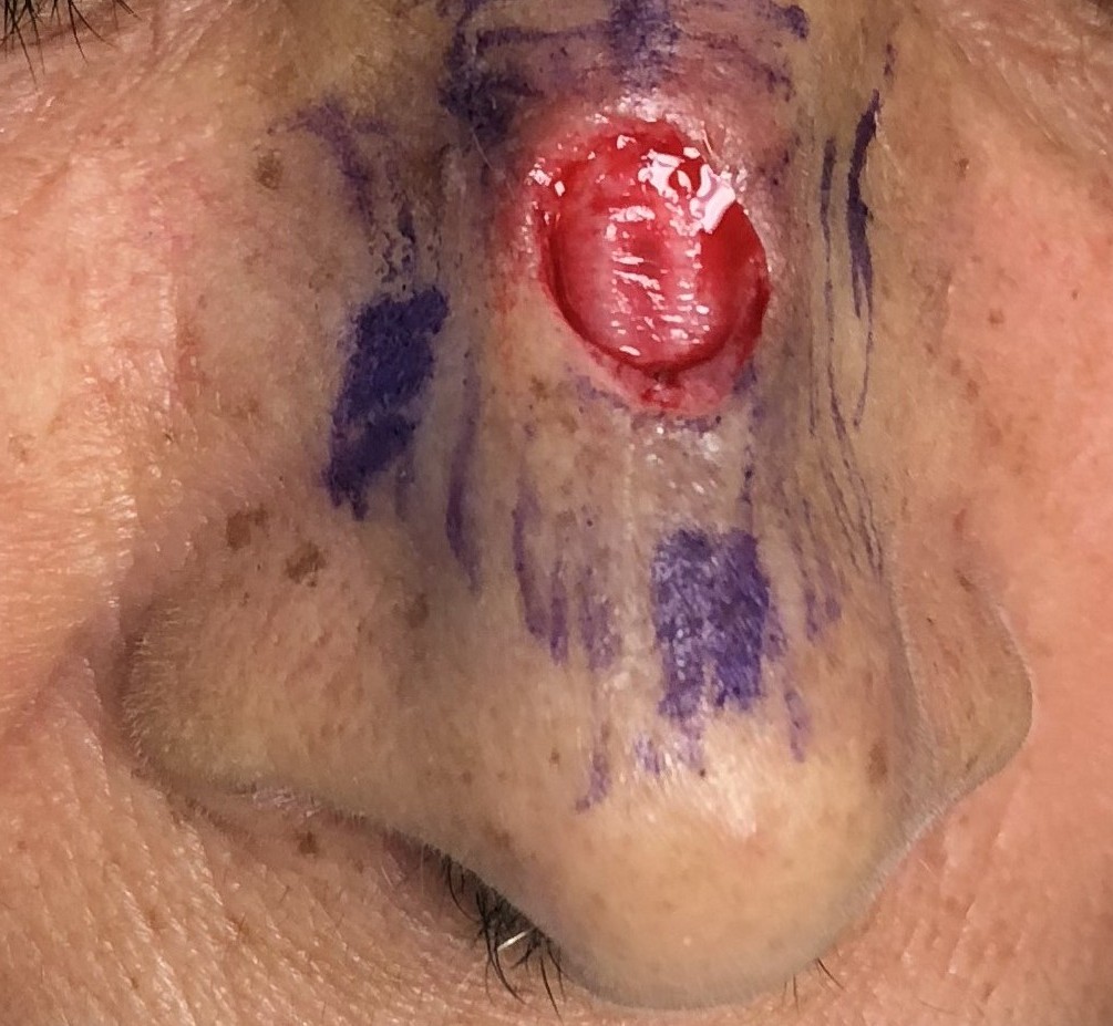 Cirugía de Mohs con control microscópico y reconstrucción