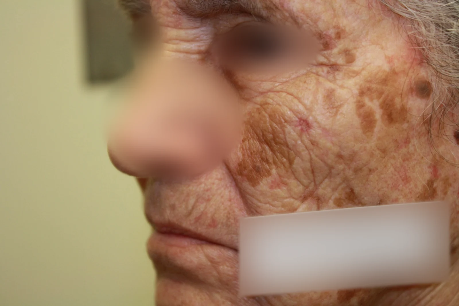 Cirugía de Mohs con control microscópico y reconstrucción