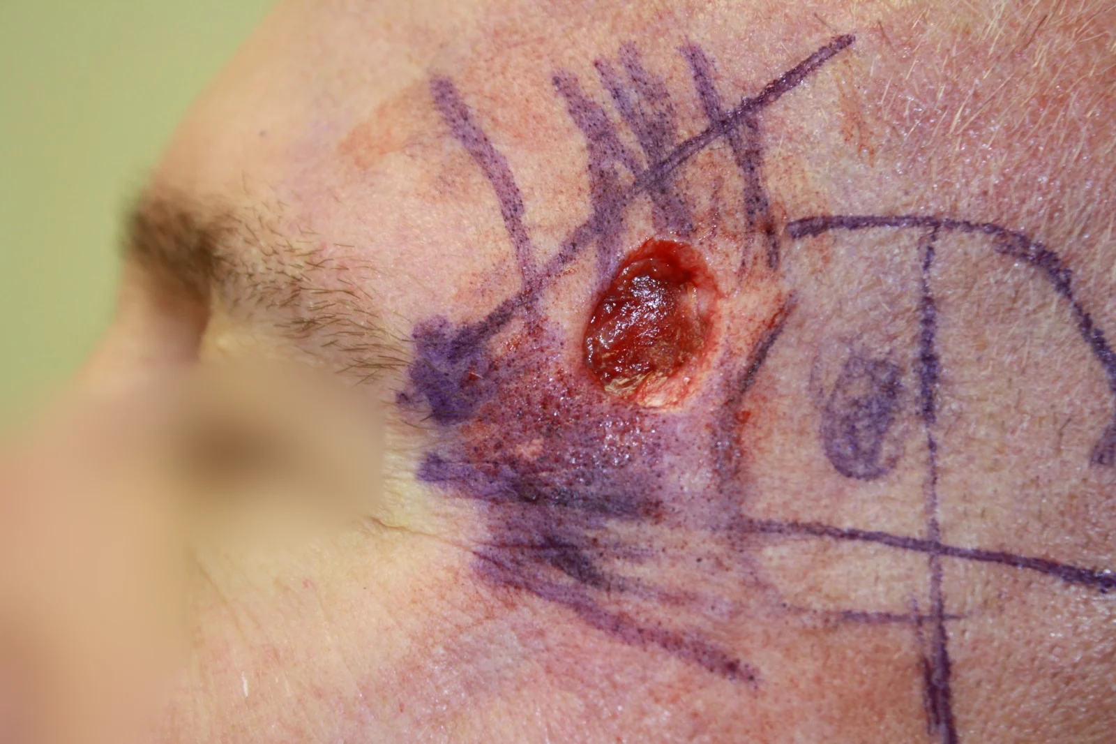 Cirugía de Mohs con control microscópico y reconstrucción: Durante el procedimiento