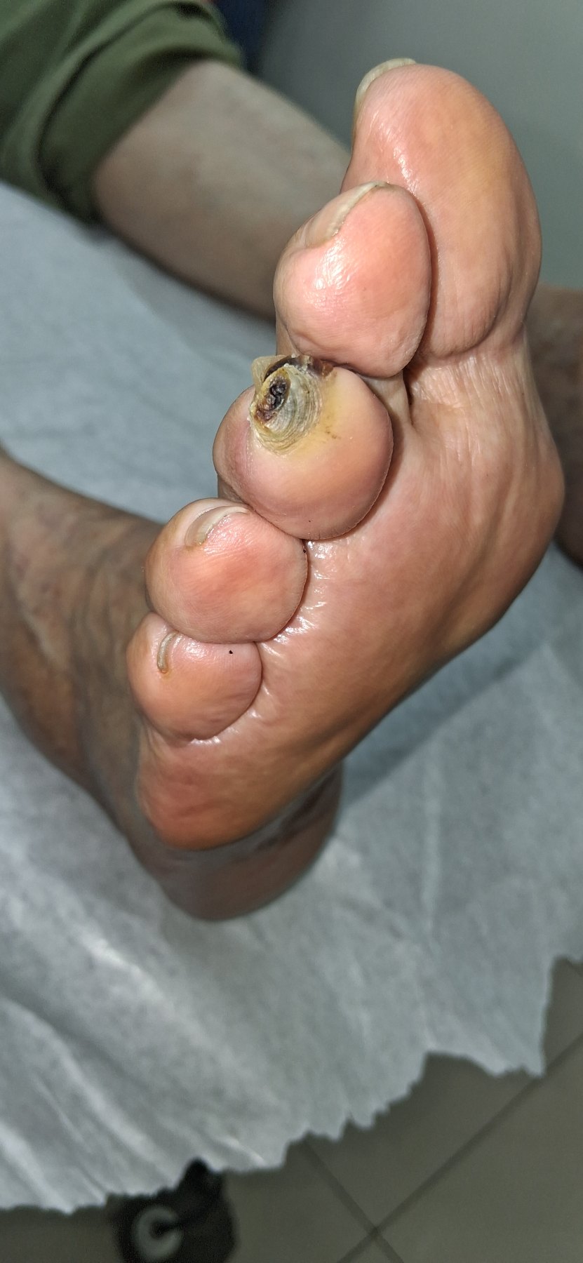 Antes: Callo