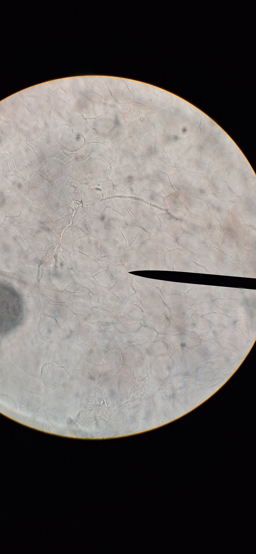 Imagen de microscopio: Onicomicosis del pie