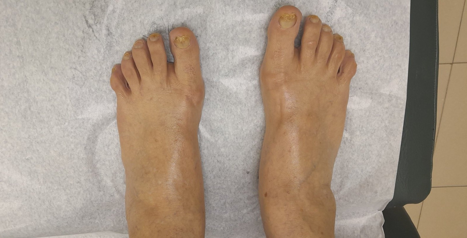 Onicomicosis del pie